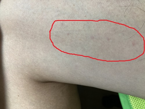 太もも内側がピリピリ・チクチク (3)